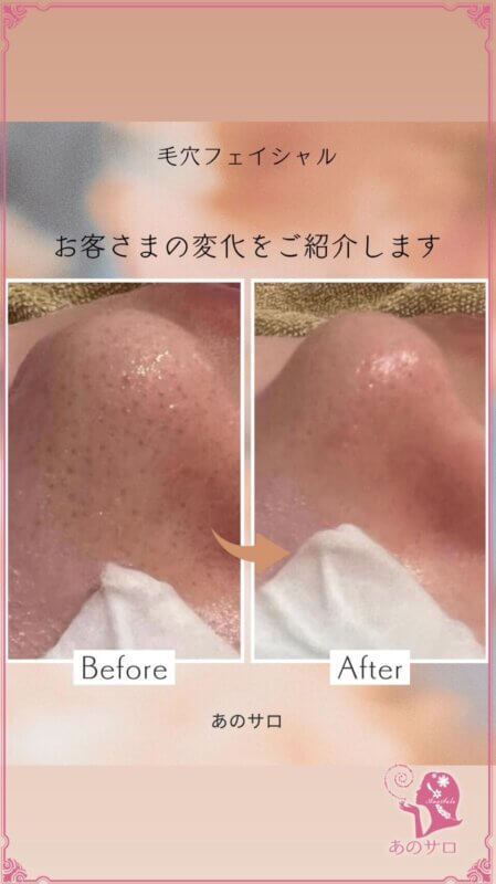 毛穴フェイシャル