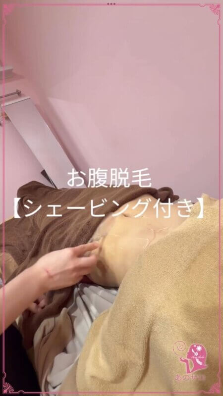 お腹の脱毛