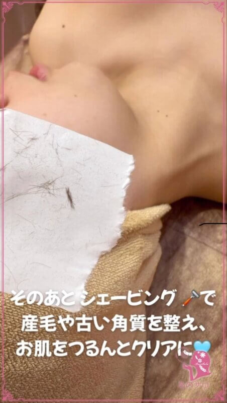 光フェイシャル